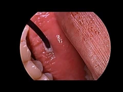 Horlama Tedavisi Radyo Frekans Plazma Jeneratörü Çok Fonksiyonlu Prob İle