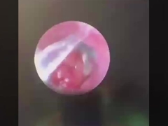 Butterfly ENT Cerrahi Araçları ENT Sondu