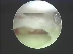 Elektrocerrahi Aletler Ablasyon Sistemleri Omurga Ve Eklemler İçin Ablasyon Ürünleri