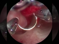 Soğuk Teknoloji Plasma Cerrahi Uroloji Uygulamaları için Elektrot