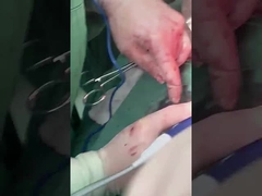 Açık ameliyat için klinik hepatoloji probu PLA408